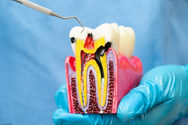 Root Canal Recovery: What To Expect After Undergoing Therapy